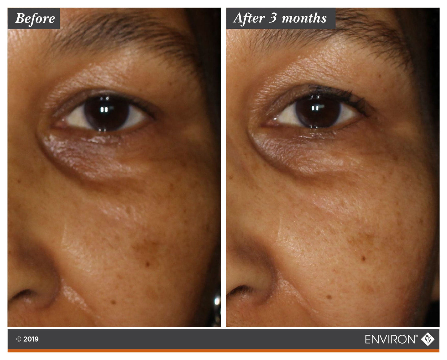 Before and after 3 months using Environ Intense C-Boost Mela-Even Cream — visible reduction in dark circles and pigmentation around the eye area