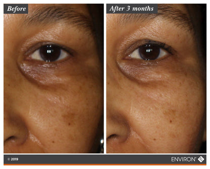 Before and after 3 months using Environ Intense C-Boost Mela-Even Cream — visible reduction in dark circles and pigmentation around the eye area