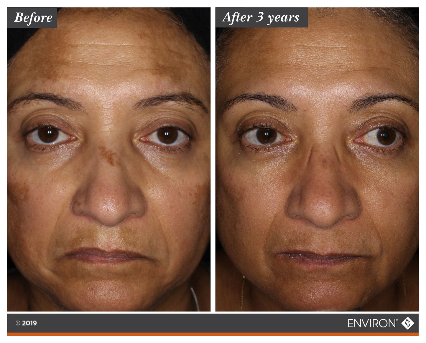 Before and after 3 years using Environ Intense C-Boost Mela-Even Cream — dramatic improvement in facial pigmentation and skin tone evenness