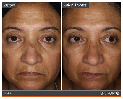 Before and after 3 years using Environ Intense C-Boost Mela-Even Cream — dramatic improvement in facial pigmentation and skin tone evenness